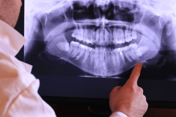 Best Emergency Wisdom Tooth Extraction in Forney, TX